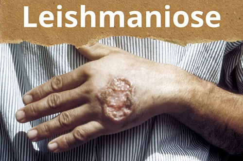 Prevenção e Controle da Leishmaniose