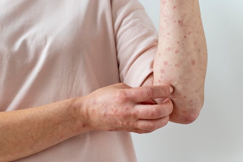 Dermatoses Ocupacionais