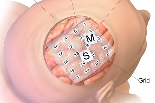 Eletrocorticografia (ECoG) Básica